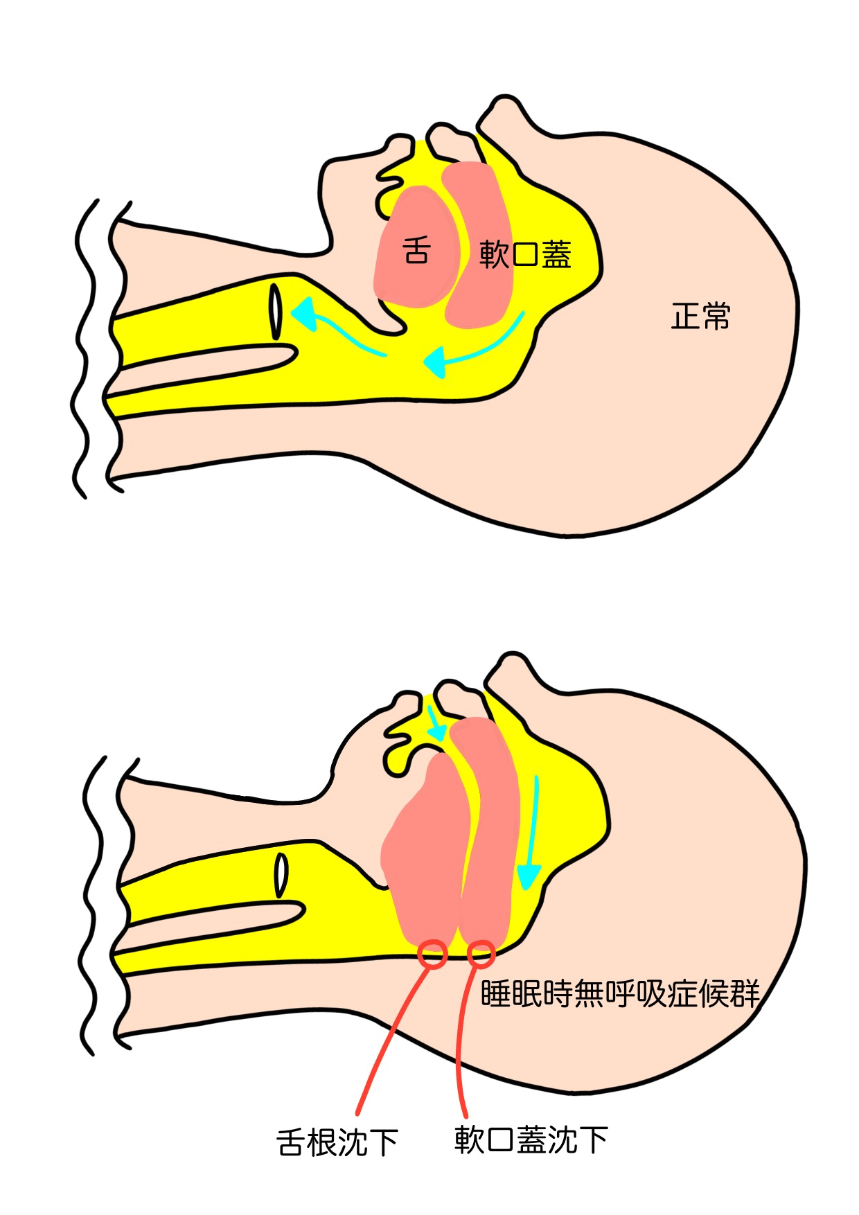 いびきの仕組み